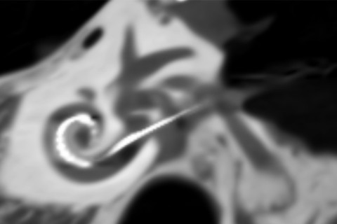 Sisäkorvan ja elektrodin kartiokeilakuva. Kuvan on ottanut Matti Iso-Mustajärvi.