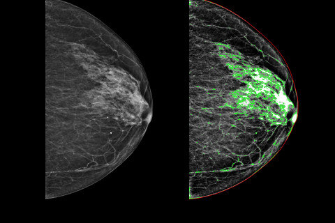 Mammografiakuva rintasyövästä.