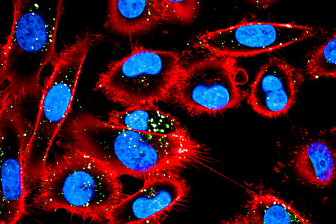 Kuvassa melanoomasoluja, joista värjätty solukalvon CD44 proteiini (punainen) ja tumat (sininen). Syöpäsolujen sisäänottamat Dil-leimatut vesikkelit näkyvät vihreällä. Kuva: Kaisa Mäki-Mantila.