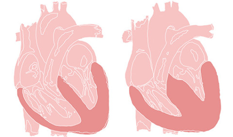 Kuvassa vasemmalla normaali ja oikealla paksuuntunut sydänlihas.