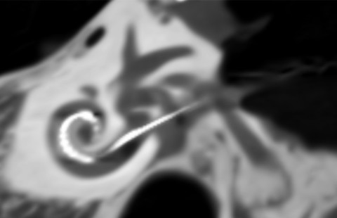 Cone-beam image of inner ear and electrode. Image by Matti Iso-Mustajärvi.
