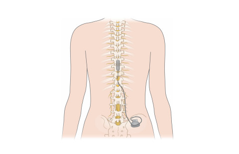 Selkäydinstimulaatiolaite