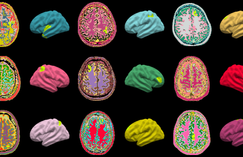 Aivomuutoksia epilepsiaa sairastavilla.