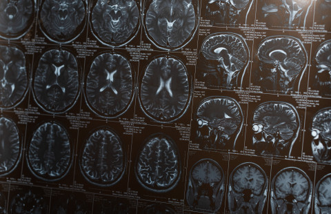 Mustavalkoisia kuvia aivojen magneettikuvauksesta