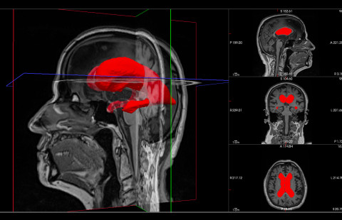Laajentuneet aivojen sivukammiot iNPH-​potilaalla. 
