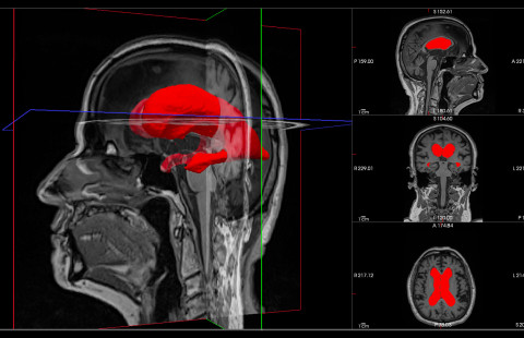 Enlarged lateral ventricles of an idiopathic normal pressure hydrocephalus patient.