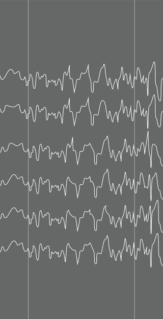 EEG pattern during epileptic seizure