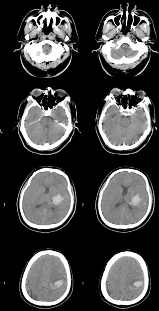 CT-kuvaa aivoista