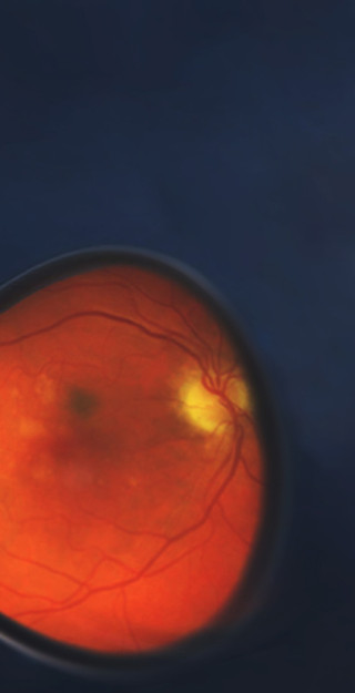 Kuvankäsittelyllä yhdistetty miRNA:n rakenne ja silmänpohjan ikärappeuman merkkejä silmässä. 