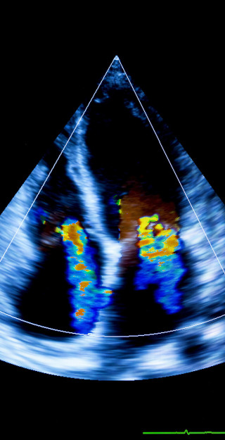 Human heart ultrasound image